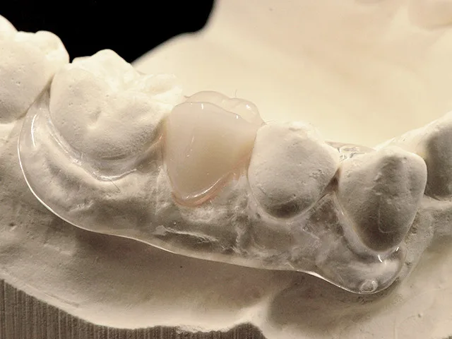 Flexprovisorium